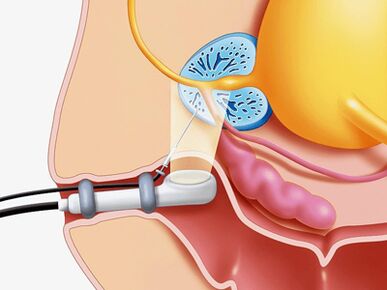 Biopsy sting of the prostate gland